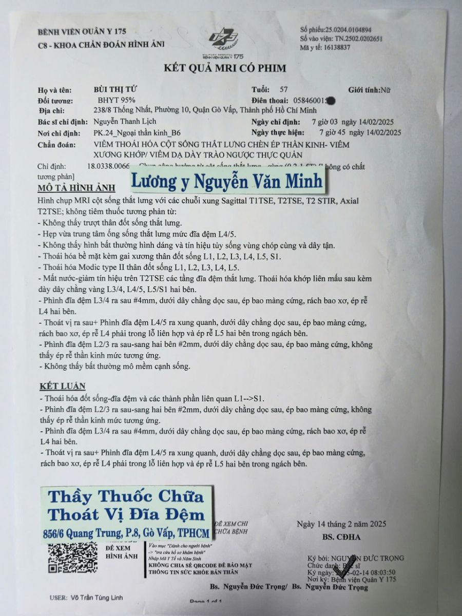 Thoát vị đĩa đệm chàn ép dây thần kinh